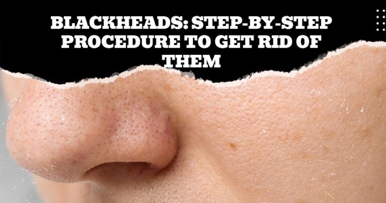 how to get rid of blackheads