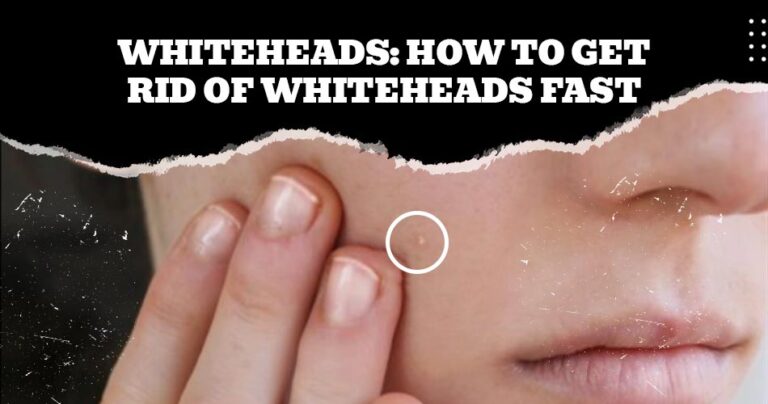 Whiteheads: How to Get Rid of Whiteheads Fast