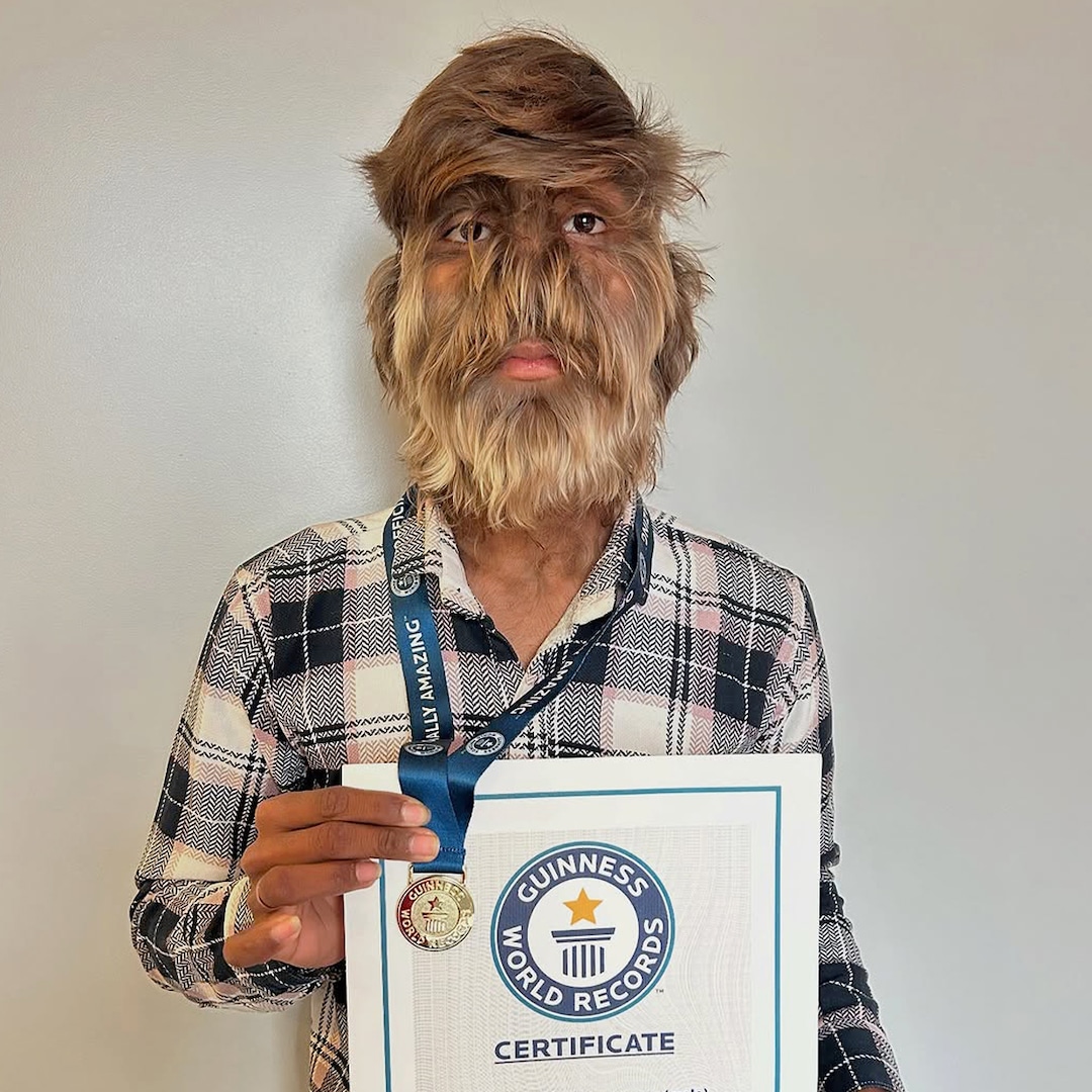 Read more about the article Lalit Patidar, 18, Sets Guinness World Record for Hairiest Face